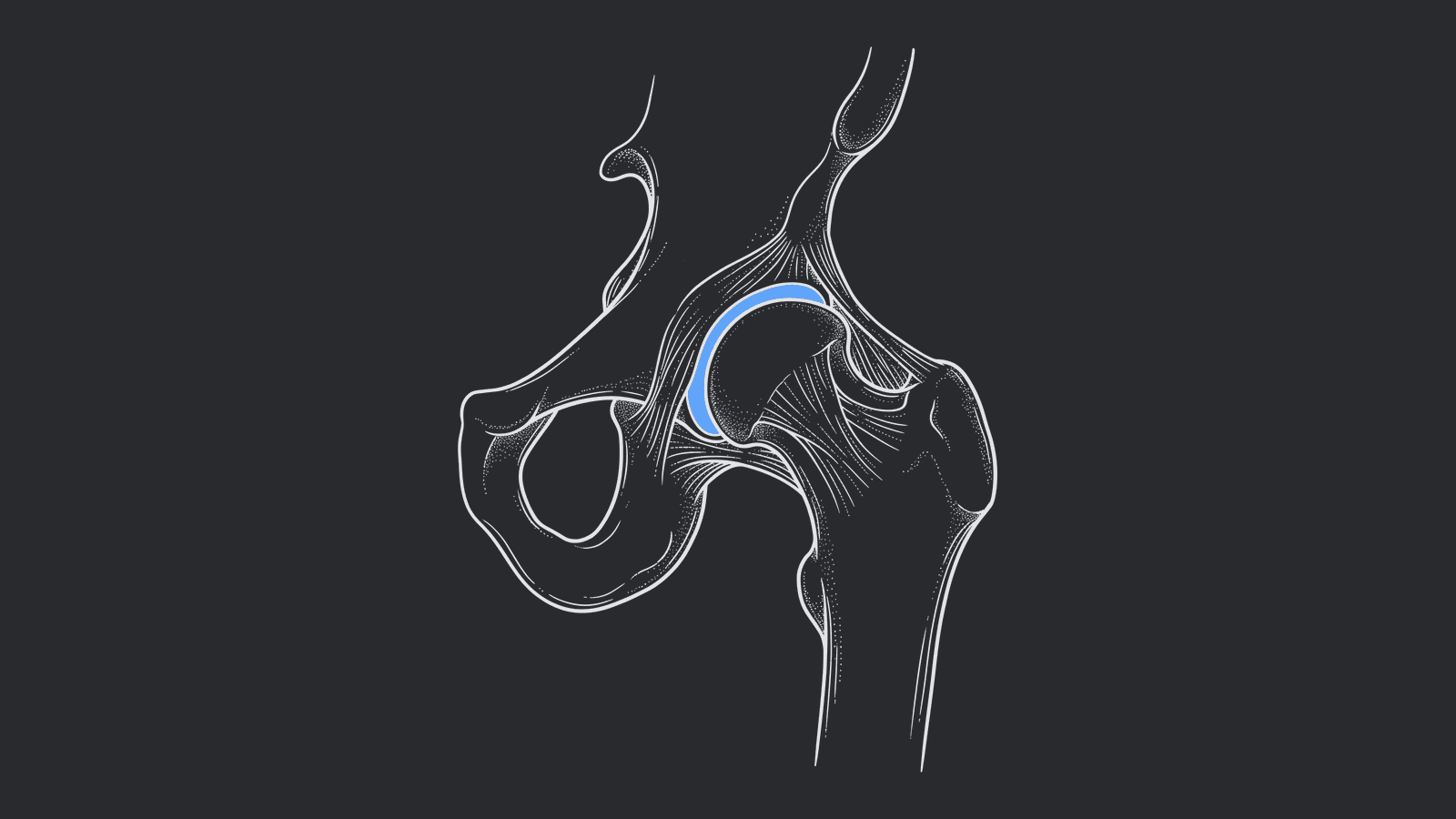 Hip Replacement