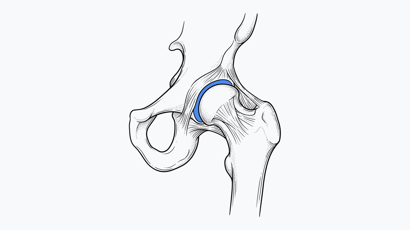 Hip Replacement