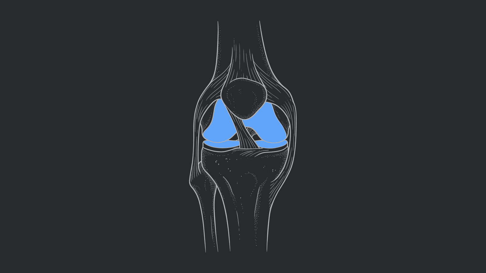Knee Replacement