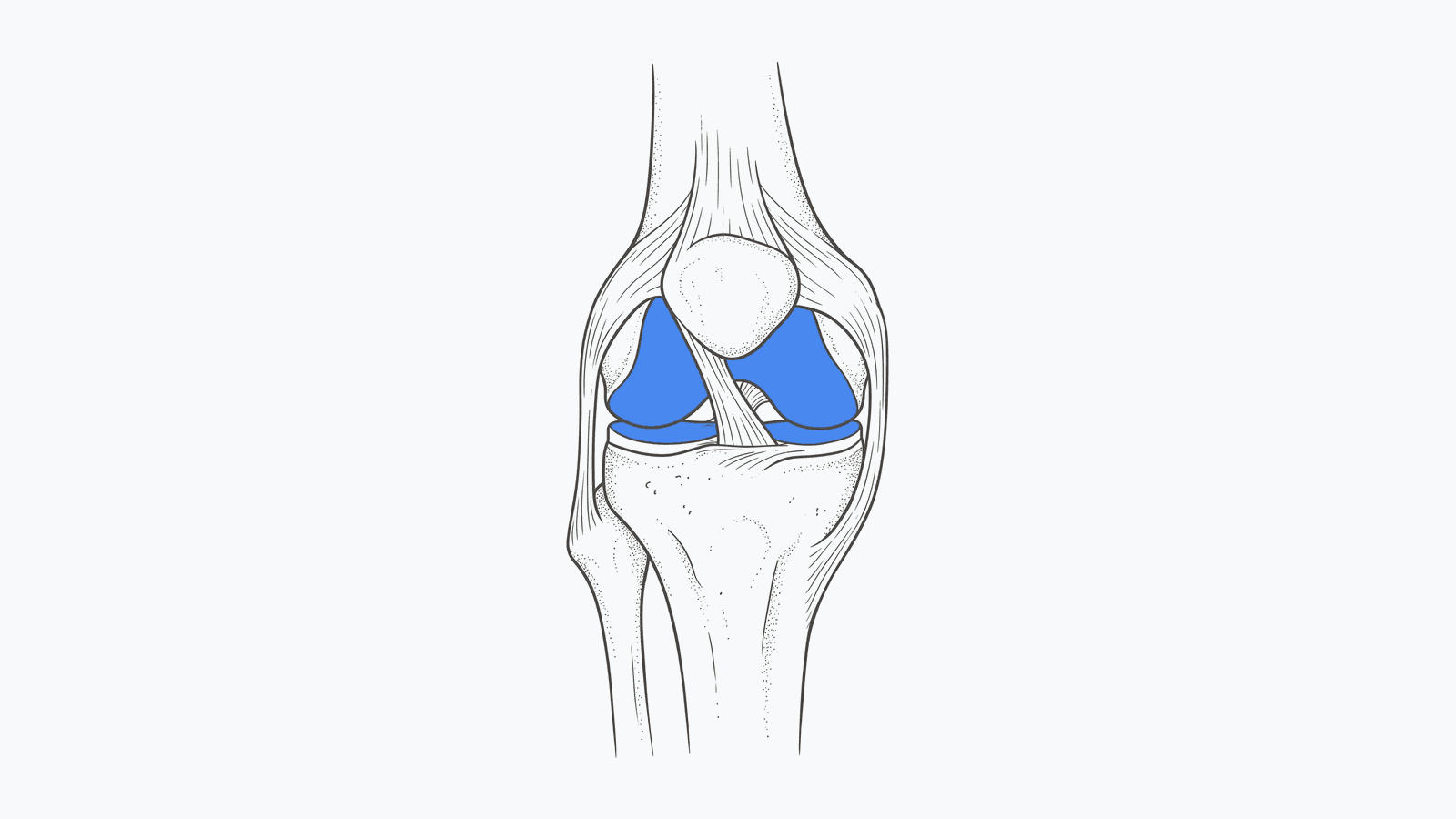 Knee Replacement