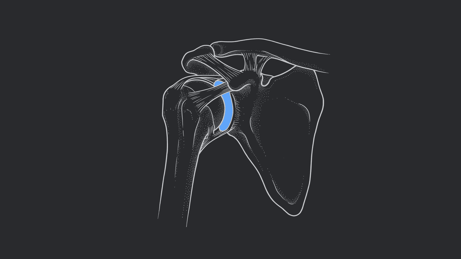 Shoulder Replacement