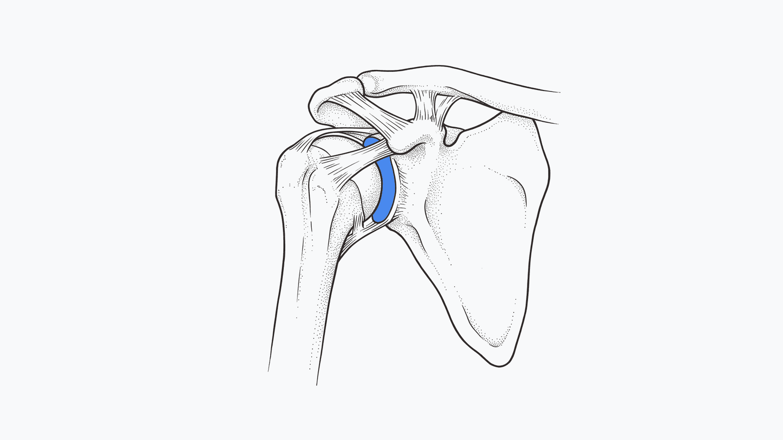 Shoulder Replacement